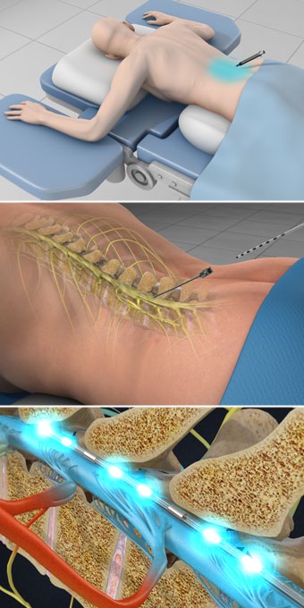 spinal-cord-stimulator-implant-trial-procedure-pain-specialists-of